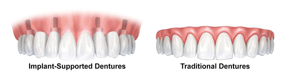 Traditional vs. implant-supported dentures